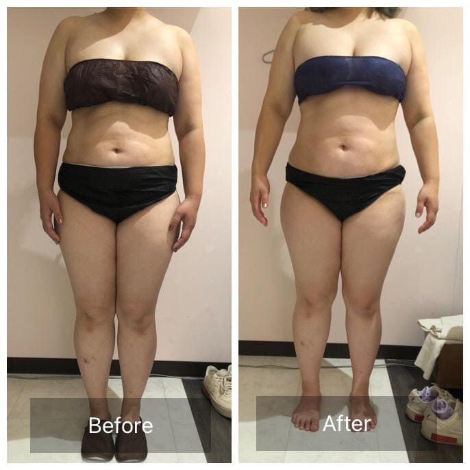 ビフォーアフター - 全身痩身コース Before